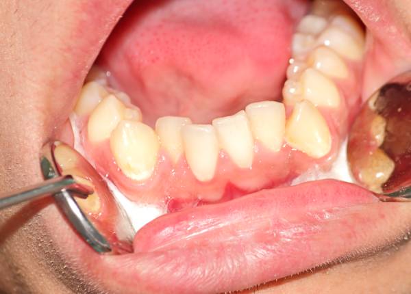 Treatment of Dental Crowding