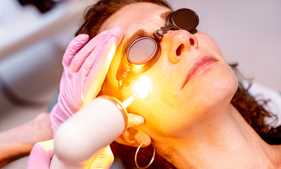 Yellow Laser Treatments for Clear, Even Skin