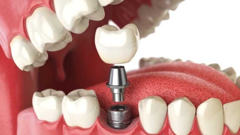 Different Types of Dental Crowns: Materials, Costs, and Benefits