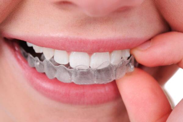 Aligner Treatment