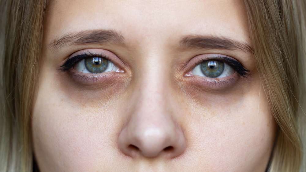 Treatment For Dark Eye Circles For Allergy-Related Shadowing