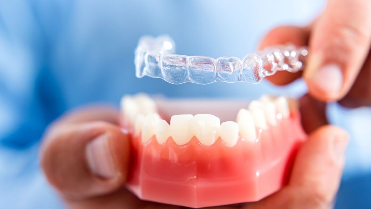 The science behind clear aligners: how they straighten their teeth
