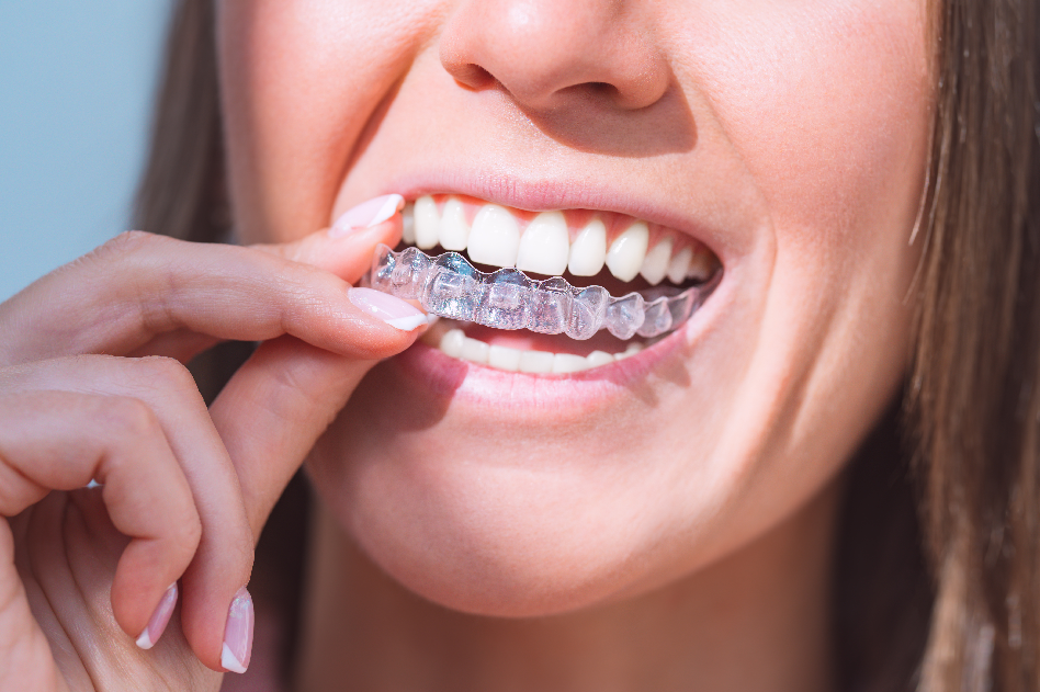 Is Invisalign Worth the Cost?