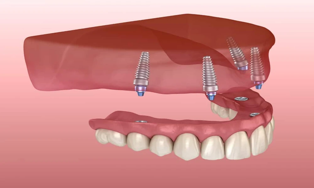 Dental Implants vs Bridges vs Dentures: An Expert Comparison for Lasting Tooth Replacement