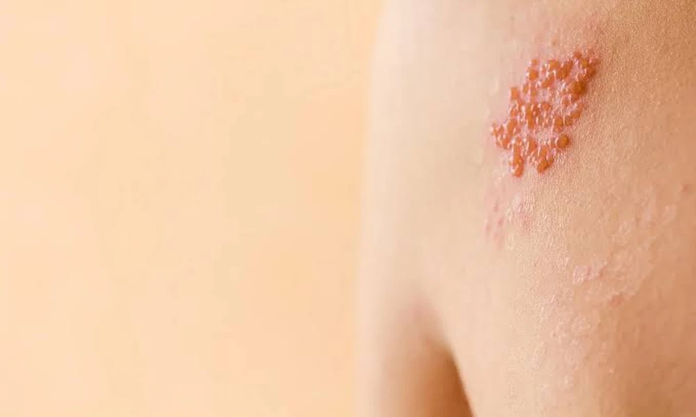 Zoster Vaccine Philippines: When Should Adults Consider Vaccination?